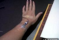 Rhabdomyolysis Update: What Patients and Clinicians Need to Know